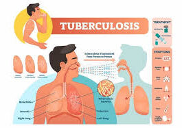 tuberculosis